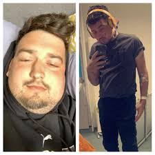 Crewe man ballooned from 11 to 20 stone in four weeks from rare kidney  disease