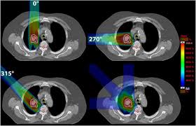 Kilian baumann is on facebook. Effects Of The Bragg Peak Degradation Due To Lung Tissue In Proton Therapy Of Lung Cancer Patients Radiation Oncology Full Text