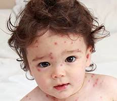 Illnesses, Virus & Pandemics