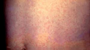 Measles: Symptoms, Diagnosis, And Treatments