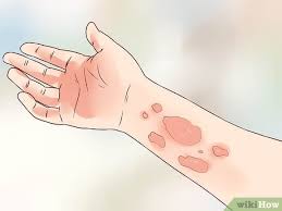 Learn possible reasons to have rashes and treatments. How To Recognize Hives Rash With Pictures Wikihow