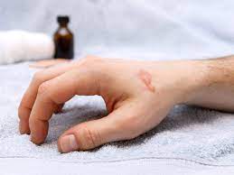 Effective Home Remedies To Soothe Burns The Times Of India