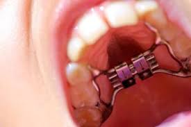 Retainers are most useful for business that need constant legal work, but do not have enough money to hire a lawyer full time. Retainers Archives Belmar Orthodontics