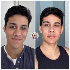 🚨 VEJA: Gutierrez Castro, criador da Leuriscleia, mostra como está ficando  o resultado da sua Cirurgia ortognática após 1 mês. Siga ↪️ @otariano para  + notícias! (Reprodução internet )