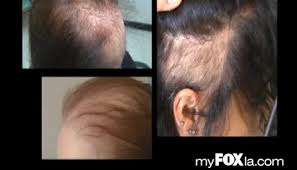 Treatment strategies start with proper education on causes and possible solutions. Female Hair Replacement Los Angeles Virtuesse Los Angeles And Hollywood