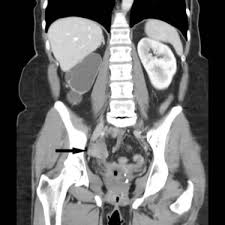 Learn about the symptoms, causes, and how to manage it. Postmenopausal Endometriosis With Ureteric Involvement Sciencedirect