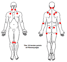 enthesitis and enthesopathy in fibromyalgia