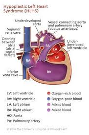 Hypoplastic Left Heart Syndrome Hlhs Children S Hospital Of Philadelphia Pediatric Heart Defects Pediatric Heart Cardiac Nursing