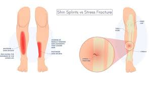Image result for Tibia Stress Fracture