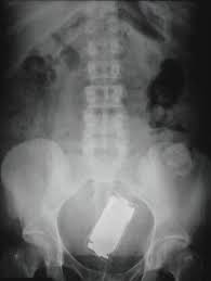 x rays that prove people will shove pretty much anything up their butts 17 pics x ray medical rays