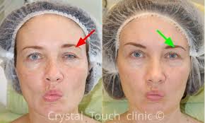 These exercises for bell's palsy can help you to regain better control of your mouth. Which Recovery Methods Can Help You To Reduce Synkinesis Crystal Touch Bell S Palsy Clinic
