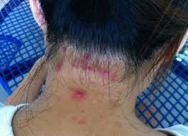 The way the pimples on the face are spoken. Scalp Acne Treatment Causes And Prevention