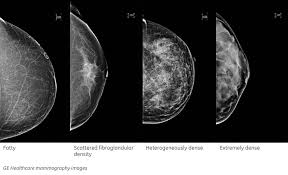 I have a family history of breast cancer and would like to know when my mammograms should start? Breast Cancer Ge News