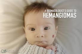 Infantile hemangiomas er røde eller rosa flekker på babyens hud som kan være flat eller hevet. Hemangiomas A Harmless Birthmark Or A Serious Health Risk