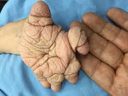 Iron deficiency anemia, esophageal webs, and dysphagia (difficulty swallowing). Plummer Vinson Syndrome The Gastrointestinalatlas Gastrointestinalatlas Com