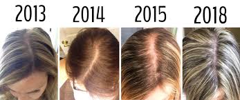 It is one of what causes female hair loss at temples. Women And Hair Loss Causes Solutions And Support First Thyme Mom