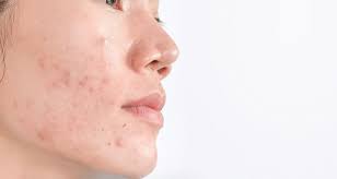 You cant actually change your skin colour.acquired tanning or acquired pigmentation can be treated with certain peels or glutathione. Hyperpigmentation Post Inflammatory Hyperpigmentation Eucerin