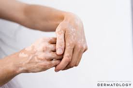 Image result for Vitiligo