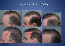 This site is intended to educate the public on hair loss topics based on personal experience and opinions from dr. Does Finasteride Regrow Hair Ask An Expert Is It Actually Possible To Regrow Hair