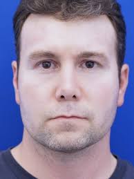 Define Upper Eyelid Crease 2626