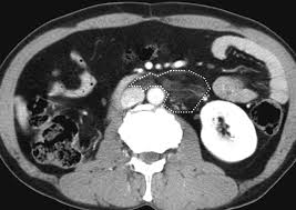 Image result for Liposarcoma