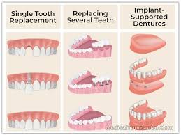How much do partial dentures cost? Dental Implants In Mexico Low Cost Full Mouth Implants