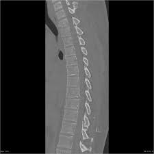 Each ligamentum flavum connects two adjacent vertebrae, beginning with the junction of the axis and third cervical vertebra, continuing down to the junction of the fifth lumbar vertebra and the sacrum. Post Traumatic Ligamentum Flavum Tear Radiology Case Radiopaedia Org