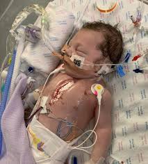 Hypoplastic Left Heart Syndrome: Huxley's Story - Tiny Tickers