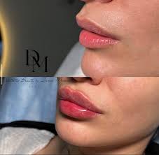 Achieve Balance and Define Your Features with Russian Techniques and Lip  Fillers
