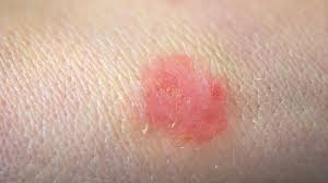 Maybe you would like to learn more about one of these? 12 Skin Conditions You Should Know About Everyday Health