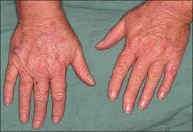 There are two types, uva and uvb. Nail Biopsy Shefalitayal