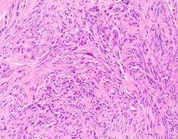 Under a microscope, sarcomatoid tissue. Pathology Outlines Diffuse Malignant Mesothelioma