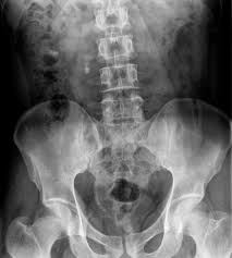Renal Calculi Xray Google Search Renal Calculi Calculus Renal