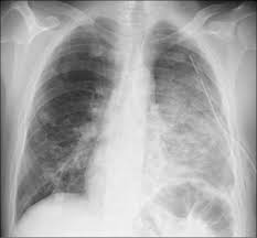 Image result for Succussion Splash