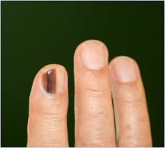 Image result for Acral lentiginous melanoma nail