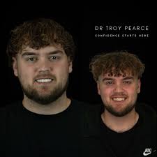 Unlocking Confidence with Micro and No Prep Porcelain Veneers