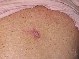 People over 40, who have. Bcc Presenting As A Back Keloid Skin Cancer And Reconstructive Surgery Center