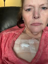 Numbing cream for tattoo port usage?