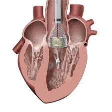 How does an artificial heart work? How Tavr Devices Work Transcatheter Aortic Valve Replacement Tavr Boston Scientific