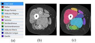 Those were the muscles of the anterior compartment of the thigh. Semantic Segmentation Of Thigh Muscle Using 2 5d Deep Learning Network Trained With Limited Datasets