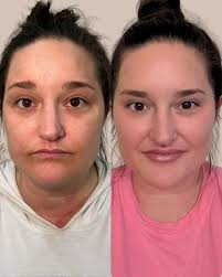 ONE YEAR PROGRESS 💫 This beautiful patient initially saw us in early 2024  for Dysport (Botox) treatment to her upper face and an initial filler  treatment with 2 syringes in her chin.