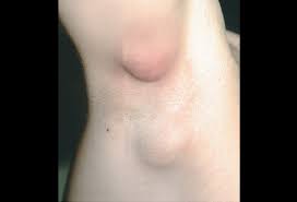 Ingrown hairs are capable of developing under skin on any area of your body, especially the face and legs, but they can be particularly annoying when they plant themselves in your armpit. Folliculitis Picture Image On Medicinenet Com