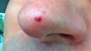 Ingrown hairs can be decreased by not shaving closely, says king. Whiteheads Zit Pimple Or Ingrown Hair Youtube