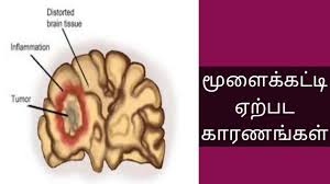 Symptoms of cancerous moles (in pictures). à®® à®³ à®• à®•à®Ÿ à®Ÿ à®à®± à®ªà®Ÿ à®• à®°à®£à®™ à®•à®³ Brain Tumor Tamil Human Health Tamil Ù…Ø¹Ù„ÙˆÙ…Ø© Ten
