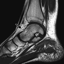 These results suggest that magnetic resonance imaging … chronic plantar fasciitis may be accompanied by muscle atrophy of plantar intrinsic foot muscles and tibialis posterior compromising the dynamic support of the foot prolonging the injury. Mr Imaging Of Entrapment Neuropathies Of The Lower Extremity Radiographics