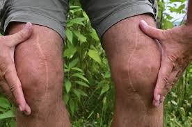 He replaced it with a cup holder. Is It Hard To Decide About Total Knee Replacement Totally Harvard Health