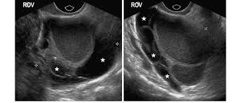 Nov 22, 2019 · complete pelvic ultrasound (upeltv) this is a complete pelvic ultrasound exam, including transabdominal and transvaginal. Transvaginal Ultrasound Images Showing Typical Features Of A Right Download Scientific Diagram