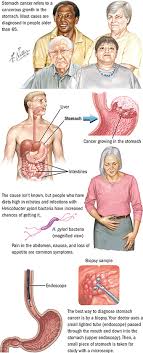 Symptoms of early stomach cancer can be similar to the symptoms of other conditions, such as stomach ulcers. Stomach Cancer Upper Gi Cancers Spectrum Health