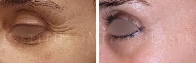 El bótox puede ser esa solución que ansias para descubrir cómo quitar arrugas de la cara y de la frente en especial, pero ¿cómo funciona? Imagenes Tratamiento De Botox Antes Y Despues Iml