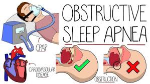 Image result for Obstructive Sleep Apnea